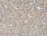 SMOC2 Antibody - Immunohistochemistry of paraffin-embedded Human liver cancer using SMOC2 Polyclonal Antibody at dilution of 1:30.