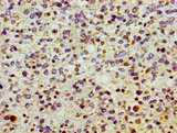 SMOX / PAO Antibody - Immunohistochemistry image of paraffin-embedded human glioma cancer at a dilution of 1:100