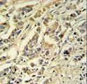 SMPDL3A Antibody - ASM3A Antibody IHC of formalin-fixed and paraffin-embedded breast carcinoma followed by peroxidase-conjugated secondary antibody and DAB staining.