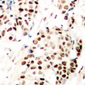 Antibody - Immunohistochemical analysis of SNAI1/2 (pS246) staining in human breast cancer formalin fixed paraffin embedded tissue section. The section was pre-treated using heat mediated antigen retrieval with sodium citrate buffer (pH 6.0). The section was then incubated with the antibody at room temperature and detected using an HRP conjugated compact polymer system. DAB was used as the chromogen. The section was then counterstained with hematoxylin and mounted with DPX.
