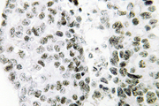 SNAI1 / SNAIL-1 Antibody - IHC of SNAI 1 (A242) pAb in paraffin-embedded human lung carcinoma tissue.