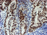 SNAI2 / SLUG Antibody - IHC of paraffin-embedded Adenocarcinoma of Human endometrium tissue using anti-SNAI2 mouse monoclonal antibody.
