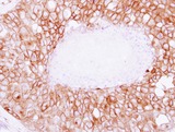 SNAP23 / SNAP-23 Antibody - IHC of paraffin-embedded Breast ca, using SNAP23 antibody at 1:250 dilution.
