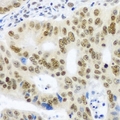 SNRPE Antibody - Immunohistochemical analysis of Sm E staining in human colon cancer formalin fixed paraffin embedded tissue section. The section was pre-treated using heat mediated antigen retrieval with sodium citrate buffer (pH 6.0). The section was then incubated with the antibody at room temperature and detected using an HRP conjugated compact polymer system. DAB was used as the chromogen. The section was then counterstained with hematoxylin and mounted with DPX.