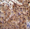 SNX24 Antibody - SNX24 Antibody immunohistochemistry of formalin-fixed and paraffin-embedded human breast carcinoma followed by peroxidase-conjugated secondary antibody and DAB staining.