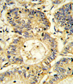 SOCS1 Antibody - Formalin-fixed and paraffin-embedded human colon carcinoma reacted with SOCS1 Antibody , which was peroxidase-conjugated to the secondary antibody, followed by DAB staining. This data demonstrates the use of this antibody for immunohistochemistry; clinical relevance has not been evaluated.