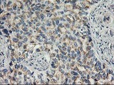 SOCS3 Antibody - IHC of paraffin-embedded Carcinoma of Human lung tissue using anti-SOCS3 mouse monoclonal antibody.