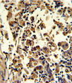 SOD3 Antibody - Formalin-fixed and paraffin-embedded human lung carcinoma reacted with SOD3 Antibody , which was peroxidase-conjugated to the secondary antibody, followed by DAB staining. This data demonstrates the use of this antibody for immunohistochemistry; clinical relevance has not been evaluated.