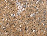 SORT1 / Sortilin Antibody - Immunohistochemistry of paraffin-embedded Human breast cancer using SORT1 Polyclonal Antibody at dilution of 1:35.