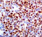 SOX11 Antibody - IHC of SOX-11 on FFPE Mantle Cell Lymphoma tissue.