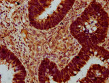 SOX30 Antibody - Immunohistochemistry Dilution at 1:400 and staining in paraffin-embedded human ovarian cancer performed on a Leica BondTM system. After dewaxing and hydration, antigen retrieval was mediated by high pressure in a citrate buffer (pH 6.0). Section was blocked with 10% normal Goat serum 30min at RT. Then primary antibody (1% BSA) was incubated at 4°C overnight. The primary is detected by a biotinylated Secondary antibody and visualized using an HRP conjugated SP system.