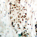 SOX9 Antibody - Immunohistochemical analysis of SOX9 staining in human breast cancer formalin fixed paraffin embedded tissue section. The section was pre-treated using heat mediated antigen retrieval with sodium citrate buffer (pH 6.0). The section was then incubated with the antibody at room temperature and detected using an HRP conjugated compact polymer system. DAB was used as the chromogen. The section was then counterstained with hematoxylin and mounted with DPX.