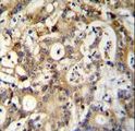 SP1 Antibody - SP1 Antibody (C-term P692) immunohistochemistry of formalin-fixed and paraffin-embedded human colon carcinoma followed by peroxidase-conjugated secondary antibody and DAB staining.