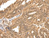 SPATA20 Antibody - Immunohistochemistry of paraffin-embedded Human ovarian cancer using SPATA20 Polyclonal Antibody at dilution of 1:70.
