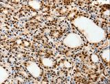SPATA20 Antibody - Immunohistochemistry of paraffin-embedded Human thyroid cancer using SPATA20 Polyclonal Antibody at dilution of 1:70.