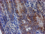 SPATC1L / C21orf56 Antibody - IHC of paraffin-embedded Adenocarcinoma of Human endometrium tissue using anti-C21orf56 mouse monoclonal antibody.