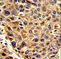 SPCS3 Antibody - Formalin-fixed and paraffin-embedded human hepatocarcinoma reacted with SPCS3 Antibody , which was peroxidase-conjugated to the secondary antibody, followed by DAB staining. This data demonstrates the use of this antibody for immunohistochemistry; clinical relevance has not been evaluated.