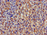 SPG21 / MAST Antibody - Immunohistochemistry of paraffin-embedded human liver cancer using SPG21 Antibody at dilution of 1:100