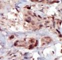 SPHK2 Antibody - Formalin-fixed and paraffin-embedded human cancer tissue reacted with the primary antibody, which was peroxidase-conjugated to the secondary antibody, followed by AEC staining. This data demonstrates the use of this antibody for immunohistochemistry; clinical relevance has not been evaluated. BC = breast carcinoma; HC = hepatocarcinoma.