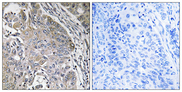 SPINK6 Antibody - Immunohistochemistry analysis of paraffin-embedded human lung carcinoma, using SPINK6 Antibody. The picture on the right is blocked with the synthesized peptide.
