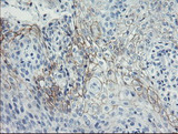 SPINT1 / HAI-1 Antibody - IHC of paraffin-embedded Carcinoma of Human bladder tissue using anti-SPINT1 mouse monoclonal antibody. (Heat-induced epitope retrieval by 10mM citric buffer, pH6.0, 100C for 10min).