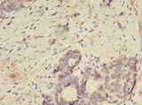 SPIRE2 Antibody - Immunohistochemistry of paraffin-embedded human gastric cancer using antibody at 1:100 dilution.  This image was taken for the unconjugated form of this product. Other forms have not been tested.