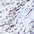 SPN / CD43 Antibody - Immunohistochemistry of paraffin-embedded human breast cancer tissue.