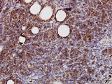 SPRY2 / Sprouty 2 Antibody - Immunoperoxidase of monoclonal antibody to SPRY2 on formalin-fixed paraffin-embedded human lymphoma. [antibody concentration 3 ug/ml].