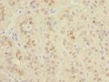 SPRYD5 Antibody - Immunohistochemistry of paraffin-embedded human liver cancer using antibody at dilution of 1:100.