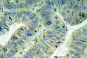 SRC Antibody - IHC of p-Src (Y418) pAb in paraffin-embedded human colon carcinoma tissue.