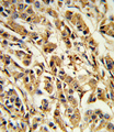 SREBF1 / SREBP-1 Antibody - Formalin-fixed and paraffin-embedded human breast carcinoma reacted with SREBF1 Antibody , which was peroxidase-conjugated to the secondary antibody, followed by DAB staining. This data demonstrates the use of this antibody for immunohistochemistry; clinical relevance has not been evaluated.