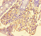 SRGAP2C Antibody - Immunohistochemistry of paraffin-embedded human colon cancer at dilution of 1:100
