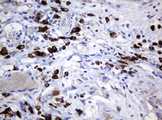 SRPRB Antibody - IHC of paraffin-embedded Carcinoma of Human bladder tissue using anti-SRPRB mouse monoclonal antibody.