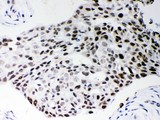 SRSF1 / SF2 Antibody - SF2 antibody IHC-paraffin: Human Mammary Cancer Tissue.