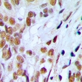SSB / La Antibody - Immunohistochemical analysis of Lupus La (pS366) staining in human prostate cancer formalin fixed paraffin embedded tissue section. The section was pre-treated using heat mediated antigen retrieval with sodium citrate buffer (pH 6.0). The section was then incubated with the antibody at room temperature and detected using an HRP polymer system. DAB was used as the chromogen. The section was then counterstained with hematoxylin and mounted with DPX.