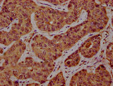 SSH1 Antibody - Immunohistochemistry Dilution at 1:300 and staining in paraffin-embedded human liver cancer performed on a Leica BondTM system. After dewaxing and hydration, antigen retrieval was mediated by high pressure in a citrate buffer (pH 6.0). Section was blocked with 10% normal Goat serum 30min at RT. Then primary antibody (1% BSA) was incubated at 4°C overnight. The primary is detected by a biotinylated Secondary antibody and visualized using an HRP conjugated SP system.