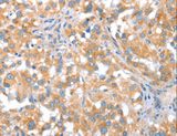 ST14 / Matriptase Antibody - Immunohistochemistry of paraffin-embedded Human thyroid cancer using ST14 Polyclonal Antibody at dilution of 1:70.
