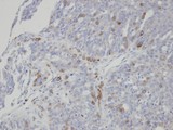 ST3GAL1 Antibody - IHC of paraffin-embedded serous OVCA using ST3GAL1 antibody at 1:100 dilution.