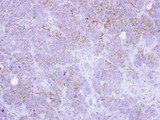 ST3GAL2 Antibody - IHC of paraffin-embedded SW480 xenograft using ST3GAL2 antibody at 1:100 dilution.