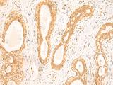 ST8SIA4 Antibody - Immunohistochemistry of paraffin-embedded Human breast cancer tissue  using ST8SIA4 Polyclonal Antibody at dilution of 1:50(×200)