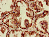 ST8SIA5 Antibody - Immunohistochemistry of paraffin-embedded human prostate cancer using ST8SIA5 Antibody at dilution of 1:100