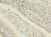 STAM2 Antibody - Immunohistochemistry of paraffin-embedded human lung cancer at dilution 1:100