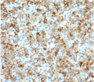 STAR Antibody - IHC staining of FFPE human testicular carcinoma with StAR antibody (clone SARP1-1). Required HIER: boil tissue sections in 10mM citrate buffer, pH 6, for 10-20 min followed by cooling at RT for 20 min.