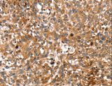 STAR Antibody - Immunohistochemistry of paraffin-embedded Human lung cancer using STAR Polyclonal Antibody at dilution of 1:35.