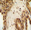 STAT2 Antibody - STAT2 Antibody immunohistochemistry of formalin-fixed and paraffin-embedded human breast carcinoma followed by peroxidase-conjugated secondary antibody and DAB staining.