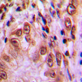 STAT4 Antibody - Immunohistochemical analysis of STAT4 (pY693) staining in human lung cancer formalin fixed paraffin embedded tissue section. The section was pre-treated using heat mediated antigen retrieval with sodium citrate buffer (pH 6.0). The section was then incubated with the antibody at room temperature and detected using an HRP conjugated compact polymer system. DAB was used as the chromogen. The section was then counterstained with hematoxylin and mounted with DPX.