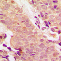 STAT5 A+B Antibody - Immunohistochemical analysis of STAT5 (pY694/699) staining in human breast cancer formalin fixed paraffin embedded tissue section. The section was pre-treated using heat mediated antigen retrieval with sodium citrate buffer (pH 6.0). The section was then incubated with the antibody at room temperature and detected using an HRP conjugated compact polymer system. DAB was used as the chromogen. The section was then counterstained with hematoxylin and mounted with DPX.