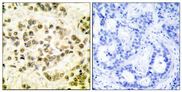 STAT5B Antibody - Immunohistochemistry analysis of paraffin-embedded human breast carcinoma, using STAT5B (Phospho-Ser731) Antibody. The picture on the right is blocked with the phospho peptide.