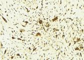 STAT6 Antibody - 1:100 staining human breast carcinoma tissue by IHC-P. The sample was formaldehyde fixed and a heat mediated antigen retrieval step in citrate buffer was performed. The sample was then blocked and incubated with the antibody for 1.5 hours at 22°C. An HRP conjugated goat anti-rabbit antibody was used as the secondary.
