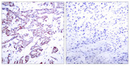 STAT6 Antibody - Immunohistochemistry analysis of paraffin-embedded human breast carcinoma, using STAT6 (Phospho-Thr645) Antibody. The picture on the right is blocked with the phospho peptide.